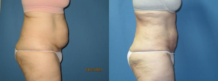 Before & After Liposuction - Abdomen / Flanks Case 175 Right Side View in Coeur d'Alene, ID