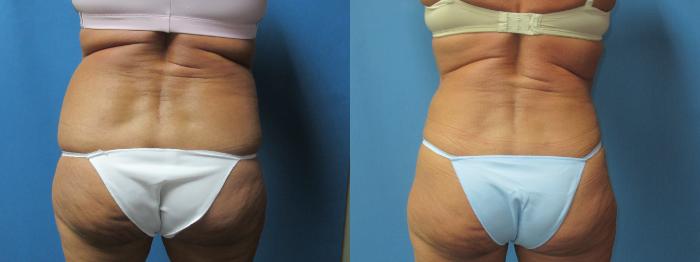 Before & After Liposuction - Abdomen / Flanks Case 180 Back View in Coeur d'Alene, ID