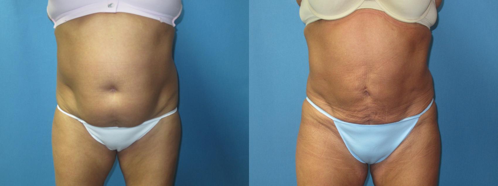 Before & After Liposuction - Abdomen / Flanks Case 180 Front View in Coeur d'Alene, ID