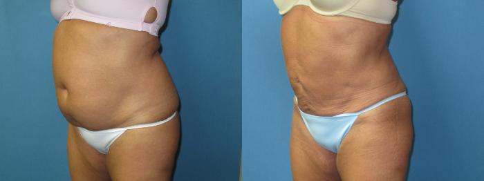 Before & After Liposuction - Abdomen / Flanks Case 180 Left Oblique View in Coeur d'Alene, ID