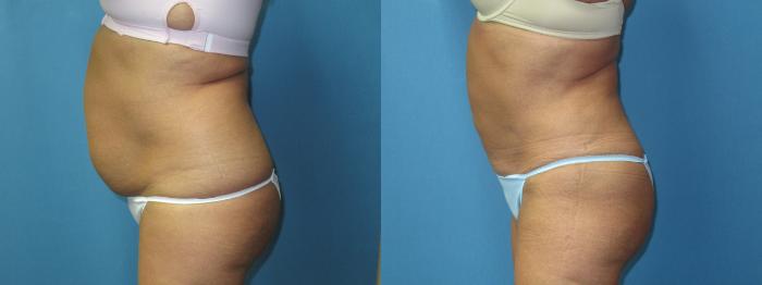 Before & After Liposuction - Abdomen / Flanks Case 180 Left Side View in Coeur d'Alene, ID