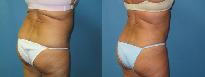 Before & After Liposuction - Abdomen / Flanks Case 180 Oblique  View in Coeur d'Alene, ID