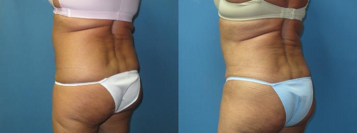 Before & After Liposuction - Abdomen / Flanks Case 180 Right Oblique View in Coeur d'Alene, ID