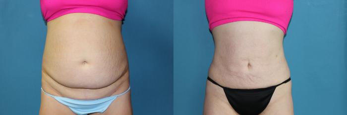 Before & After Liposuction - Abdomen / Flanks Case 187 Front View in Coeur d'Alene, ID