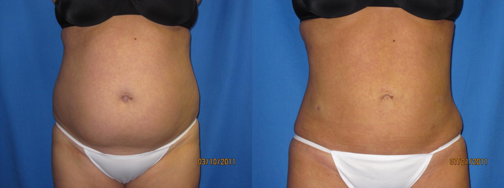 Before & After Liposuction - Abdomen / Flanks Case 19 View #1 View in Coeur d'Alene, ID