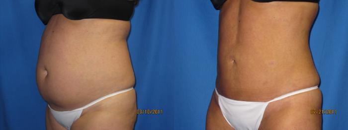 Before & After Liposuction - Abdomen / Flanks Case 19 View #2 View in Coeur d'Alene, ID