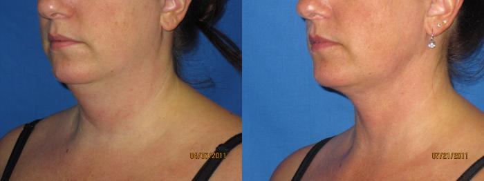 Before & After Liposuction - Abdomen / Flanks Case 19 View #3 View in Coeur d'Alene, ID
