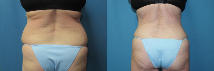 Before & After Liposuction - Abdomen / Flanks Case 196 Back View in Coeur d'Alene, ID