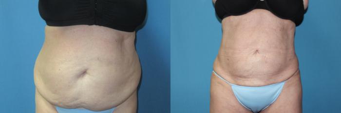 Before & After Liposuction - Abdomen / Flanks Case 196 Front View in Coeur d'Alene, ID