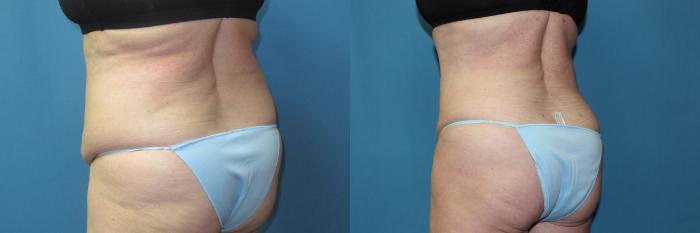 Before & After Liposuction - Abdomen / Flanks Case 196 Left Back - Oblique View in Coeur d'Alene, ID