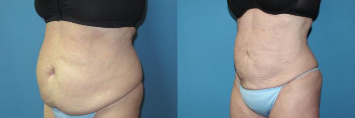 Before & After Liposuction - Abdomen / Flanks Case 196 Left Oblique View in Coeur d'Alene, ID