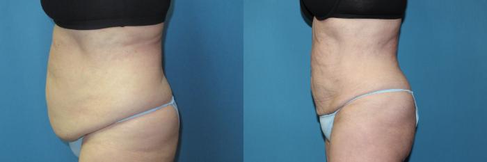 Before & After Liposuction - Abdomen / Flanks Case 196 Left Side View in Coeur d'Alene, ID