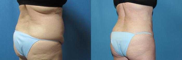 Before & After Liposuction - Abdomen / Flanks Case 196 Right Back - Oblique View in Coeur d'Alene, ID