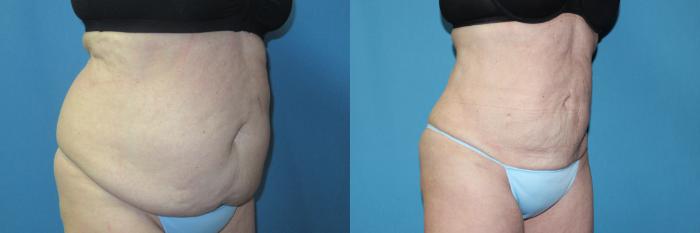 Before & After Liposuction - Abdomen / Flanks Case 196 Right Oblique View in Coeur d'Alene, ID