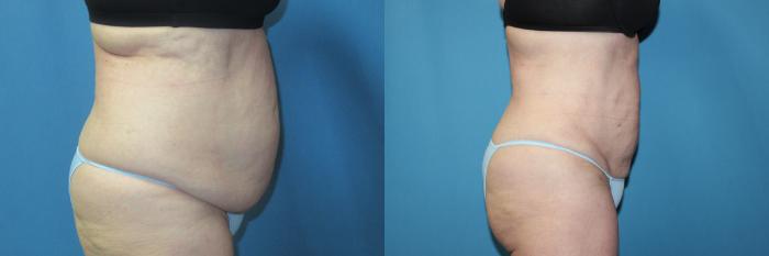 Before & After Liposuction - Abdomen / Flanks Case 196 Right Side View in Coeur d'Alene, ID