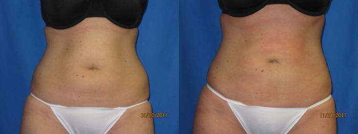 Before & After Liposuction - Abdomen / Flanks Case 23 View #1 View in Coeur d'Alene, ID