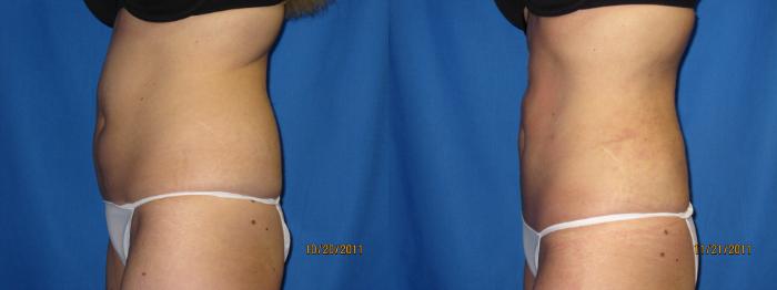 Before & After Liposuction - Abdomen / Flanks Case 23 View #2 View in Coeur d'Alene, ID