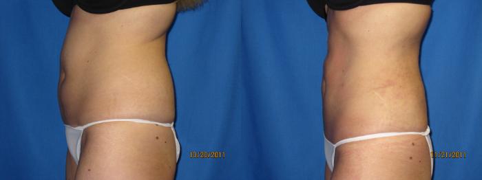 Liposuction - Abdomen / Flanks Before and After Photo Gallery, Coeur  d'Alene, ID