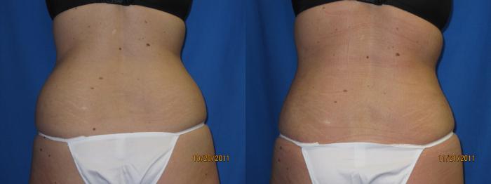 Before & After Liposuction - Abdomen / Flanks Case 23 View #3 View in Coeur d'Alene, ID