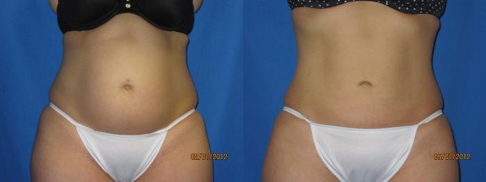 Liposuction of Flanks Before and After 3804