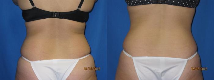 Before & After Liposuction - Abdomen / Flanks Case 26 View #3 View in Coeur d'Alene, ID