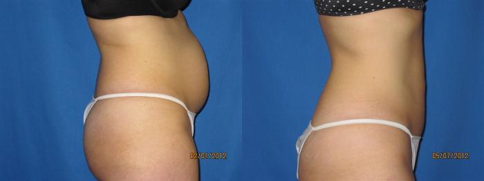 Before & After Liposuction - Abdomen / Flanks Case 26 View #4 View in Coeur d'Alene, ID