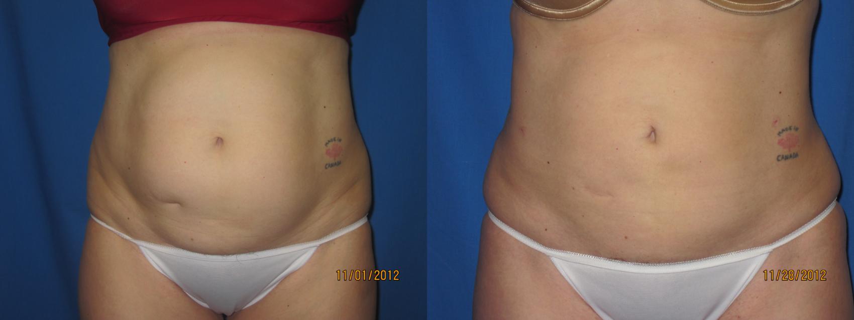 Before & After Liposuction - Abdomen / Flanks Case 32 View #1 View in Coeur d'Alene, ID