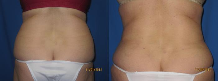 Before & After Liposuction - Abdomen / Flanks Case 32 View #2 View in Coeur d'Alene, ID