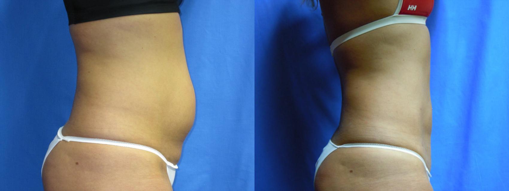 The importance of doing liposuction of the lower back and flanks during a  tummy tuck