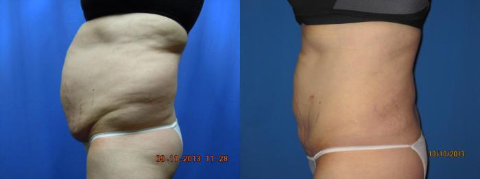 Before & After Liposuction - Abdomen / Flanks Case 46 View #1 View in Coeur d'Alene, ID