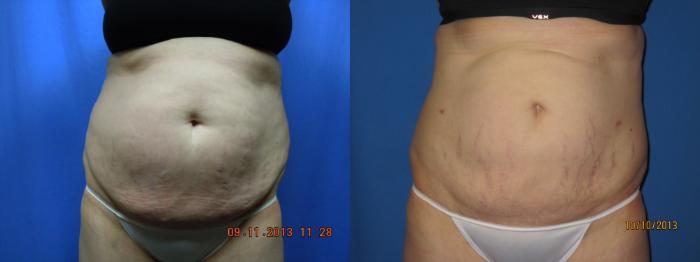 Before & After Liposuction - Abdomen / Flanks Case 46 View #2 View in Coeur d'Alene, ID