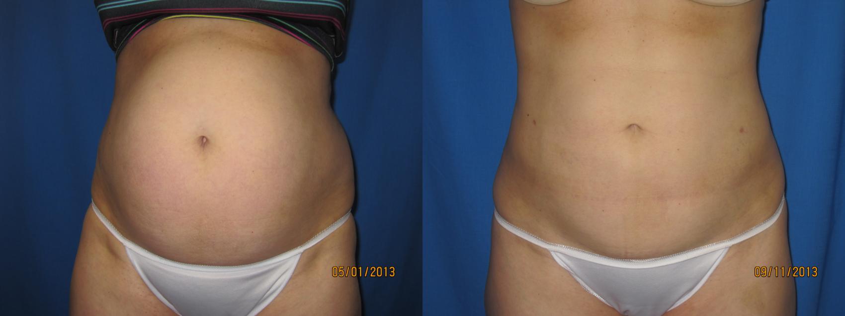 Liposuction Abdomen Flanks Before And After Pictures Case