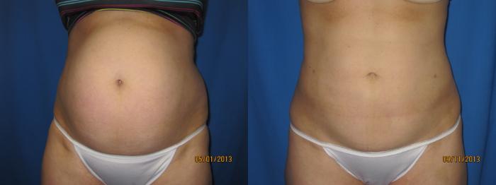 Before & After Liposuction - Abdomen / Flanks Case 47 View #1 View in Coeur d'Alene, ID