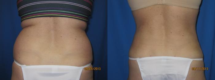 Before & After Liposuction - Abdomen / Flanks Case 47 View #2 View in Coeur d'Alene, ID