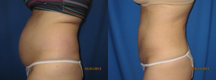 Before & After Liposuction - Abdomen / Flanks Case 47 View #3 View in Coeur d'Alene, ID