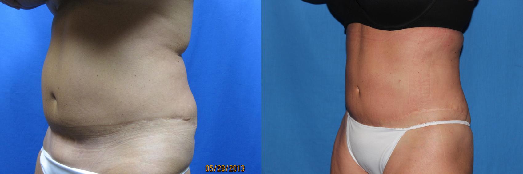 Flank Liposuction Before and After - Glow Aesthetic Medicine