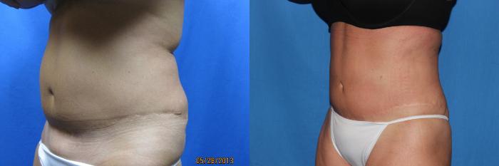 Before & After Liposuction - Abdomen / Flanks Case 50 View #1 View in Coeur d'Alene, ID