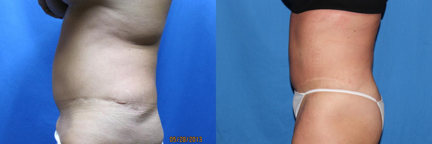 Before & After Liposuction - Abdomen / Flanks Case 50 View #2 View in Coeur d'Alene, ID