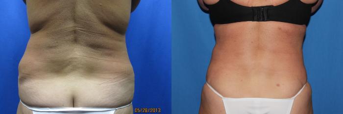 Before & After Liposuction - Abdomen / Flanks Case 50 View #3 View in Coeur d'Alene, ID