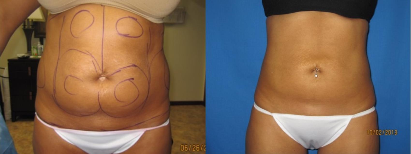 Before & After Liposuction - Abdomen / Flanks Case 54 View #1 View in Coeur d'Alene, ID
