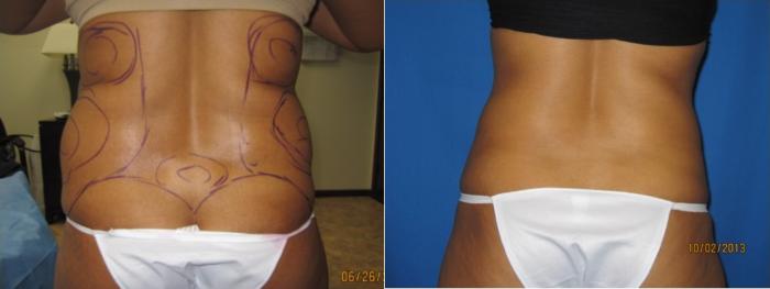 Before & After Liposuction - Abdomen / Flanks Case 54 View #2 View in Coeur d'Alene, ID