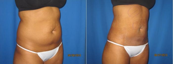 Before & After Liposuction - Abdomen / Flanks Case 55 View #1 View in Coeur d'Alene, ID