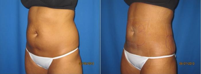 Before & After Liposuction - Abdomen / Flanks Case 55 View #2 View in Coeur d'Alene, ID