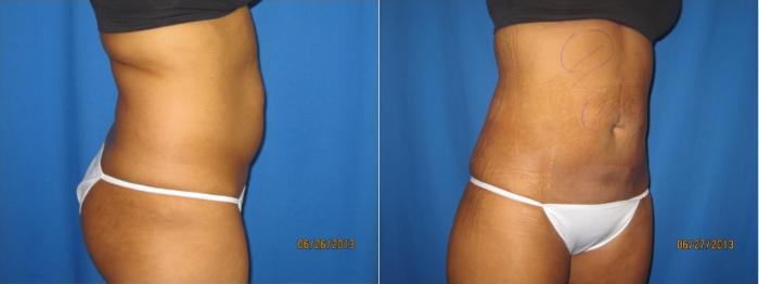 Before & After Liposuction - Abdomen / Flanks Case 55 View #3 View in Coeur d'Alene, ID