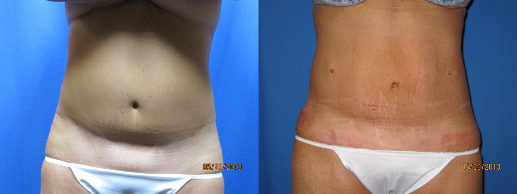 Before & After Liposuction - Abdomen / Flanks Case 57 View #1 View in Coeur d'Alene, ID