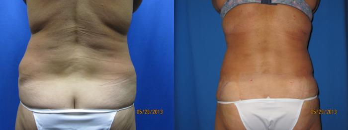 Before & After Liposuction - Abdomen / Flanks Case 57 View #2 View in Coeur d'Alene, ID