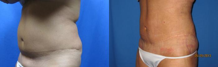 Before & After Liposuction - Abdomen / Flanks Case 57 View #3 View in Coeur d'Alene, ID