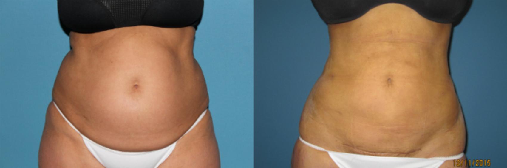 Before & After Liposuction - Abdomen / Flanks Case 59 View #1 View in Coeur d'Alene, ID