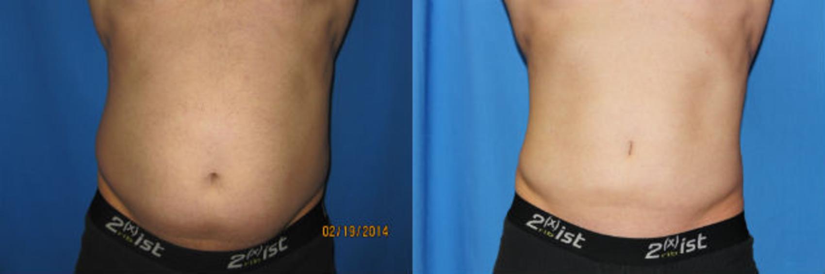 Before & After Liposuction - Abdomen / Flanks Case 61 View #1 View in Coeur d'Alene, ID