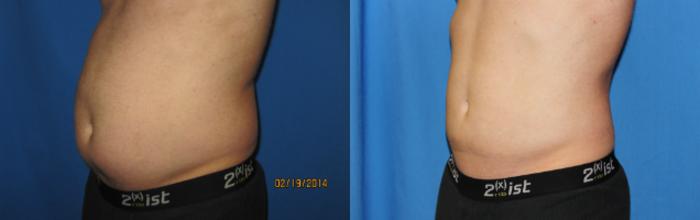 Before & After Liposuction - Abdomen / Flanks Case 61 View #2 View in Coeur d'Alene, ID